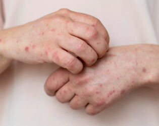 Sarampo volta a assustar: Casos explodem nas Am&eacute;ricas e Brasil confirma 1&ordm; registro em SP.