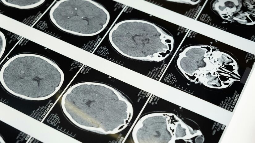 Na sequência, os neurônios entram em um "tsunami cerebral", um colapso eletroquímico chamado que causa a destruição celular e, então, vem o fim da atividade cerebral organizada / Pexels
