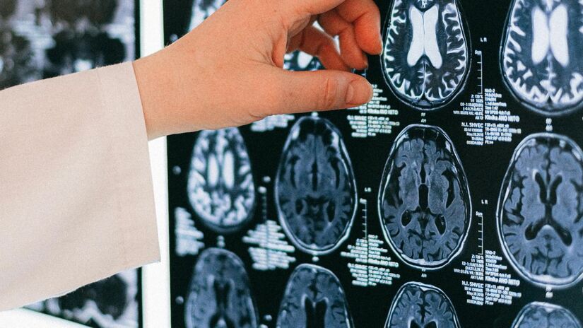 4 - Já foram encontrado plásticos dentro do corpo humano e até mesmo no cérebro - Pexels