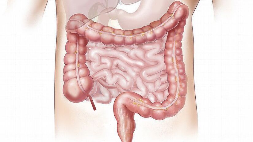 Doenças inflamatórias intestinais crônicas podem favorecer o surgimento do câncer colorretal / Pixabay