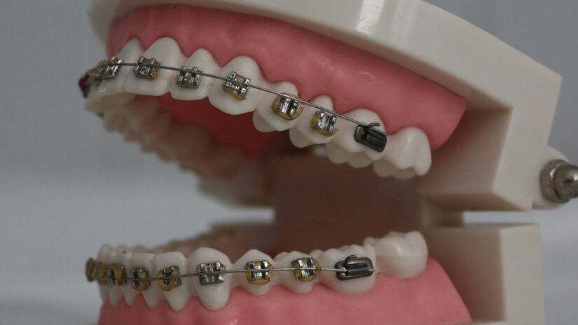 Os dentes inferiores costumam apresentar maior tendência a entortar novamente, devido ao espaço reduzido entre eles e à pressão constante da mordida e da língua. Unsplash/Aman yadav
