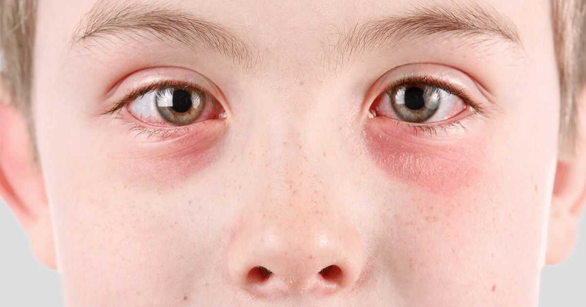 Conjuntivite nas crianças pode ser sintoma de infecção pela covid-19 -  Diário do Litoral