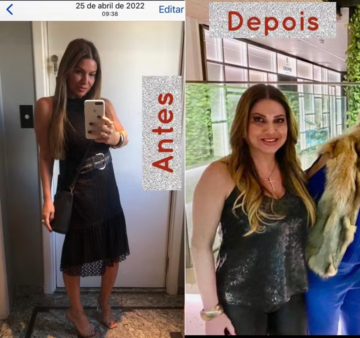 Antes e depois do implante hormonal da decoradora Ana Karina, de 53 anos