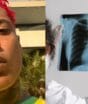 O que é tuberculose pulmonar? Entenda a doença grave que a defesa do rapper Oruam alega que ele enfrenta