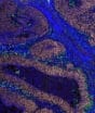 Cientistas descobrem células que agem como “faxineiras do corpo” e devoram câncer vivo
