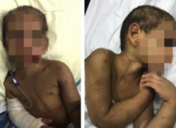 Devido à gravidade das lesões, o menino foi encaminhado à UTI