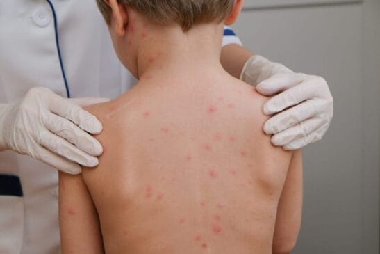 Há um surto de meningite meningocócica este ano em diversos estados do país