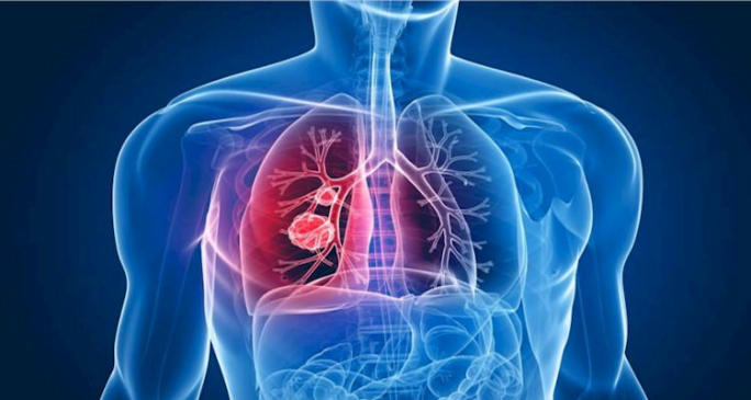 Em 2018, 10 milhões de pessoas adoeceram com TB e 1,5 milhão morreram da doença, principalmente em países de baixa e média renda
