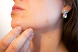 A dermatologista recomenda alguns cuidados simples, como reduzir o consumo de açúcar e chocolate, manter a pele limpa e hidratada e usar produtos específicos para o cuidado da pele oleosa
