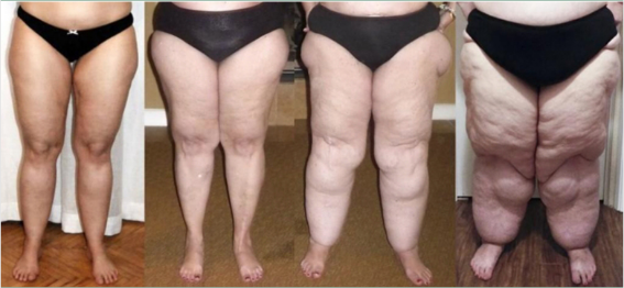 O Lipedema no Brasil afeta hoje uma em cada dez mulheres, o que soma cerca de 5 milhões de brasileiras