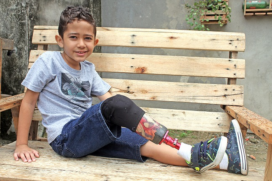 Arthur, de 6 anos, tem que trocar a prótese na perna para poder praticar esportes e andar