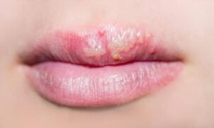 Profissicional alerta sobre causas, tratamentos e como se prevenir da doeça Hesper Labial