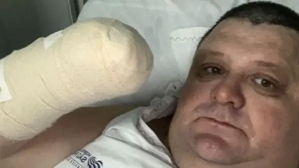 Humorista Pilha perdeu uma das mãos após acidente em Santa Catarina