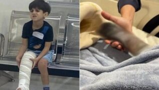 À direita, Yuri em primeiros atendimentos médicos, em Guarujá; à esquerda, pé gangrenado semanas depois