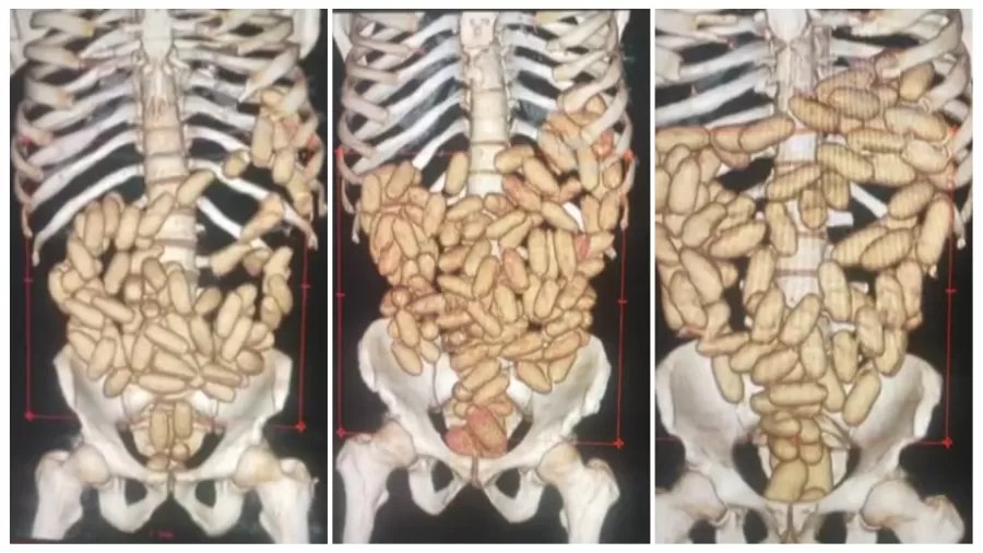 Os homens foram conduzidos imediatamente a um hospital público para que pudessem passar por exames e, caso confirmada a ingestão, expelir as cápsulas com a droga de forma segura, informou a PF (Polícia Federal)