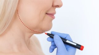 Dermatologia avança e oferece soluções modernas contra a gordura abaixo do queixo