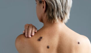 Segundo os cientistas, a nova substância atua diretamente no ciclo celular do melanoma, impedindo que as células se multipliquem