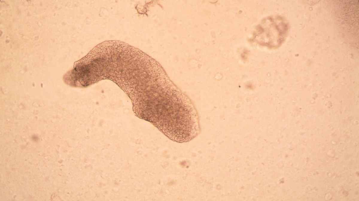 A informação foi confirmada pelo jornal americano CBS News, que informou ainda que o paciente está internado na unidade de terapia intensiva