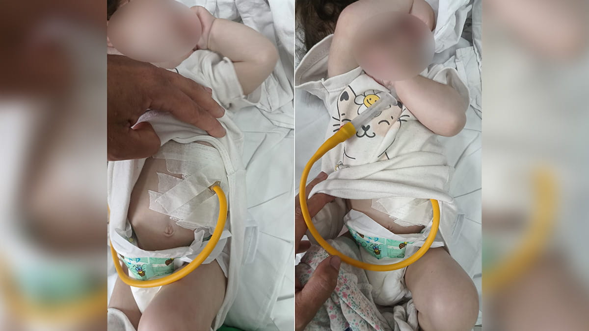 A bebê usa a sonda de alimentação desde que nasceu, pois foi diagnosticada com paralisia cerebral