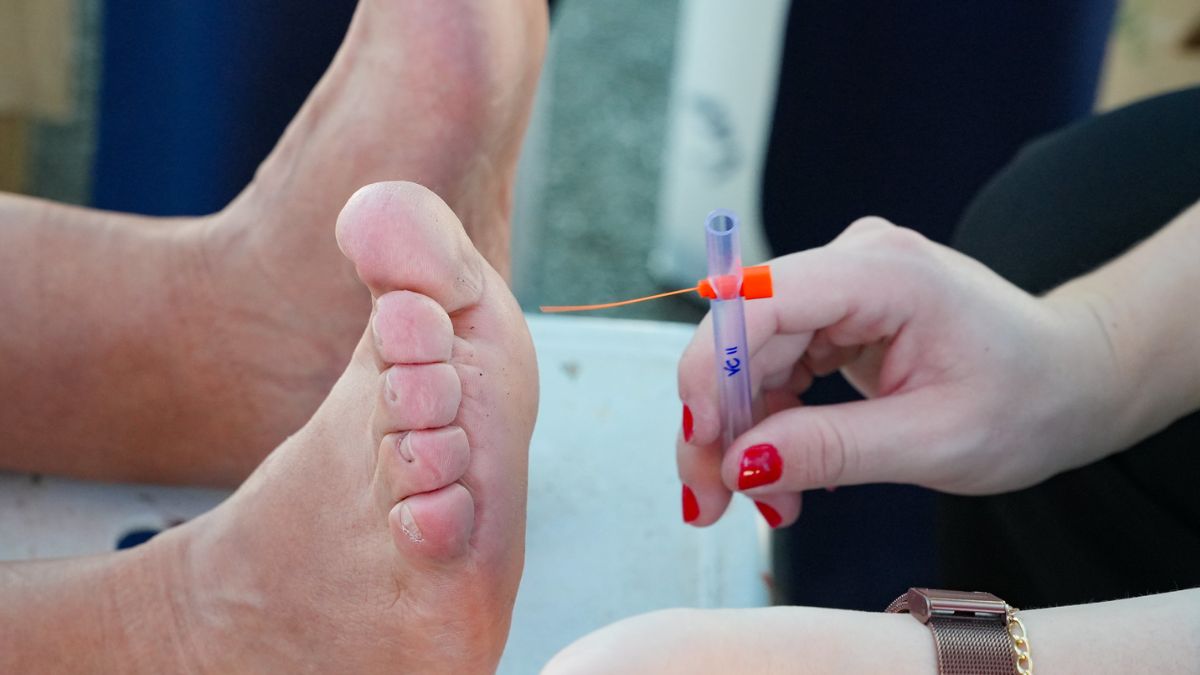 O pé diabético é uma das complicações mais sérias da Diabetes Mellitus