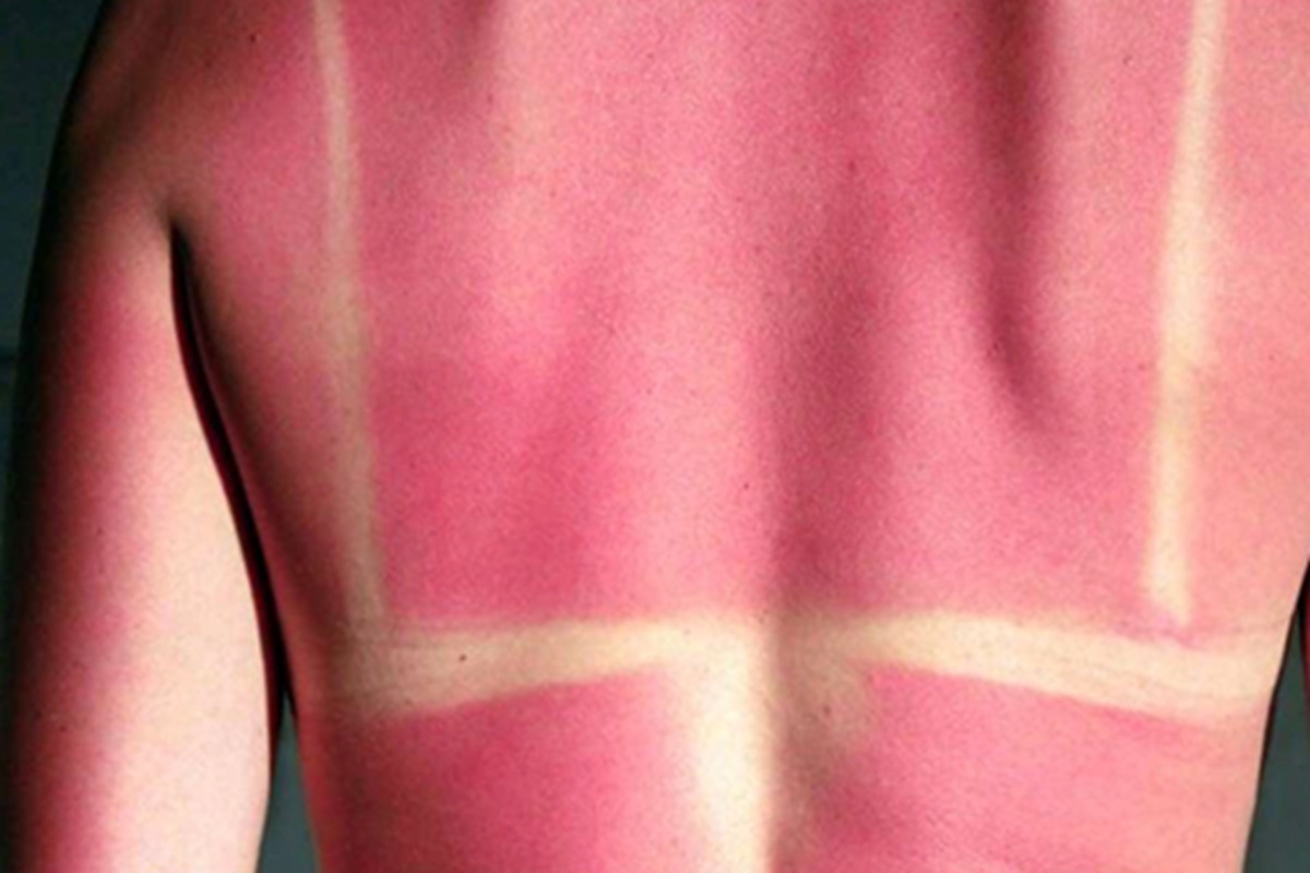 Atendimentos por sintomas provocados pelas altas temperaturas aumentam no Litoral de SP