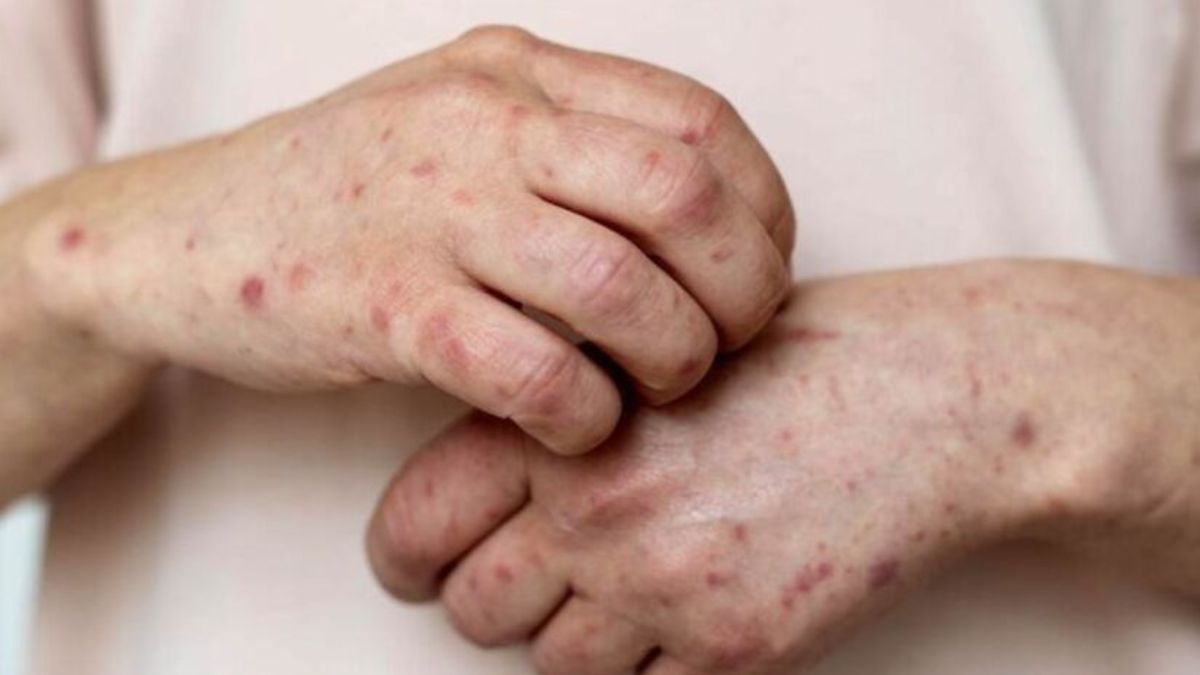 Variante combina dois clados do vírus e pode exigir resposta mais rápida