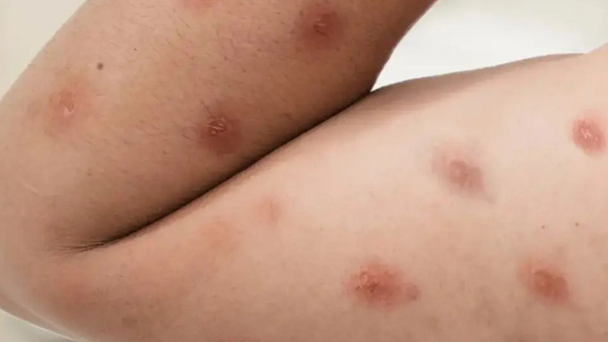 Febre, lesões na pele e ínguas estão entre os sinais; período de incubação pode chegar a 21 dias