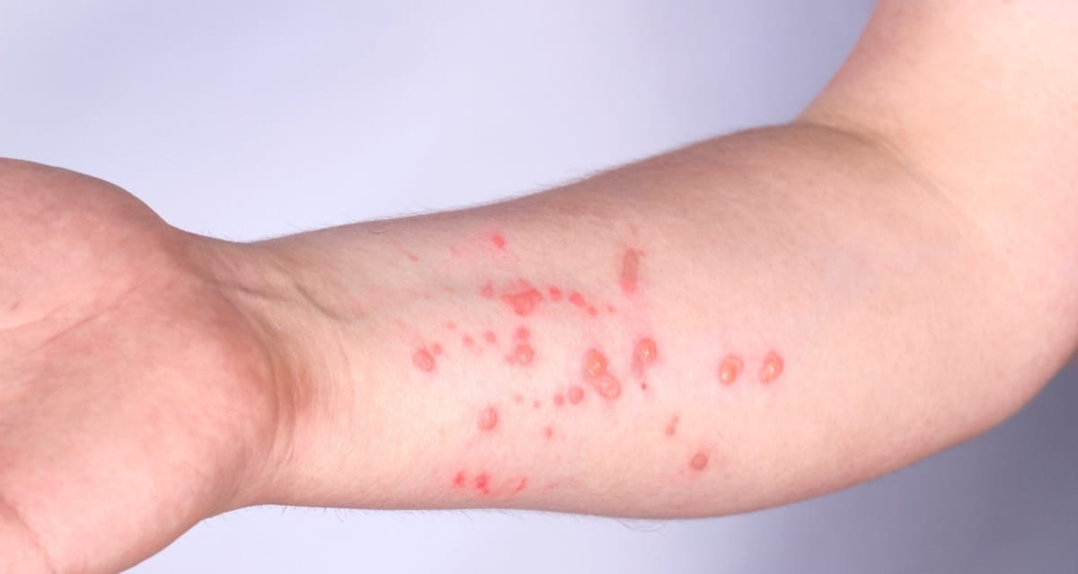 Especialistas da Sociedade Brasileira de Infectologia são enfáticos: nunca manipule as lesões