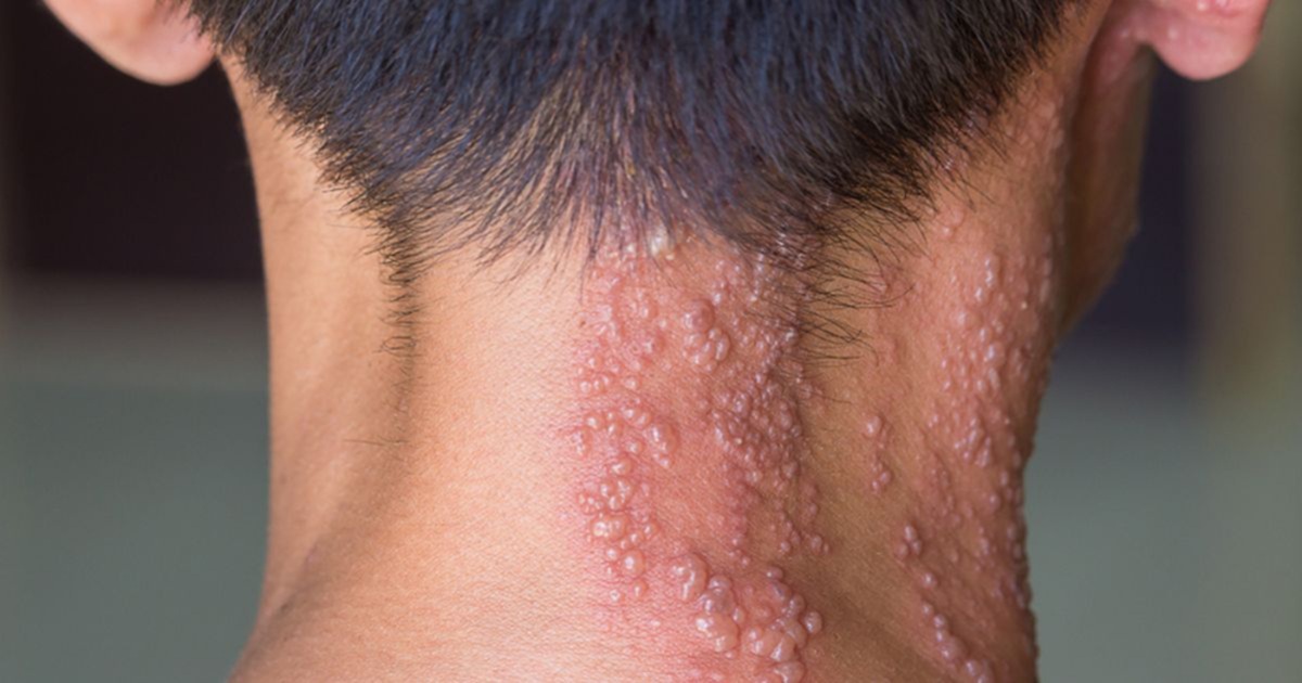 Deputada quer que Governo Federal inclua o imunizante contra a doença no Programa Nacional de Imunizações (PNI)