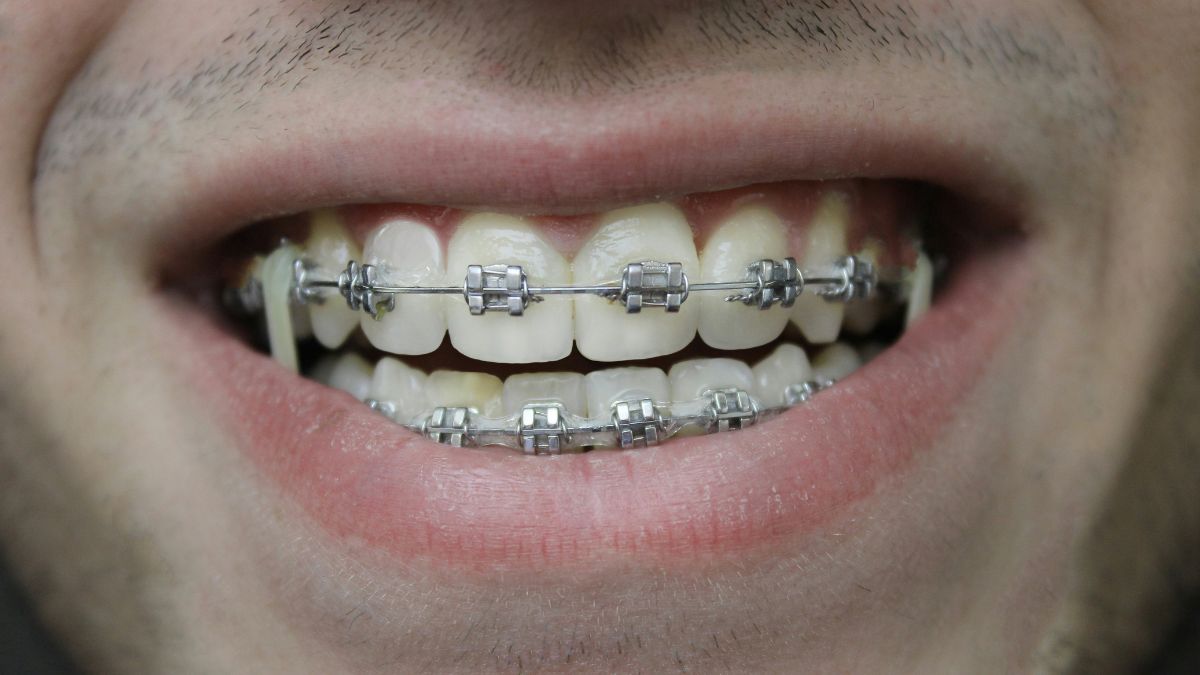 Durante o uso do aparelho, forças controladas estimulam a remodelação óssea, processo biológico que permite o deslocamento gradual dos dentes. Unsplash/Ozkan Guner