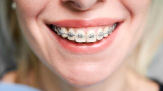 Dentes não ficam totalmente fixos ao longo da vida: mudanças naturais podem provocar movimentações dentárias, mesmo após o tratamento ortodôntico