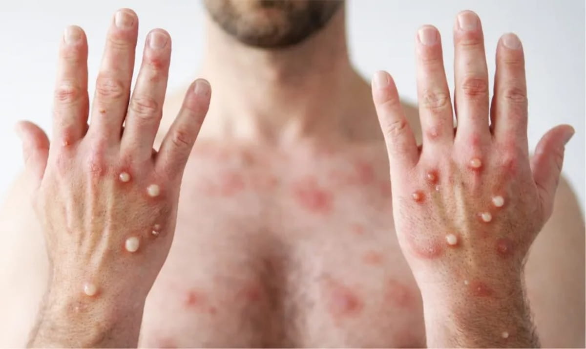 O que parecia algo banal acabou se transformando em um longo período de isolamento, dor intensa e incertezas após o diagnóstico de mpox.