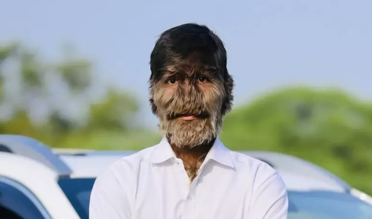 Lalit compartilha com seus milhares de seguidores nas redes sociais como lida com as limitações físicas